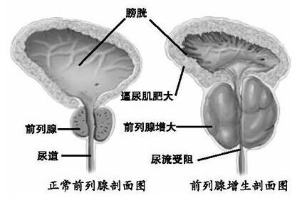 前列腺癌最新治疗进展揭秘，前沿疗法助你战胜病魔🚀💉